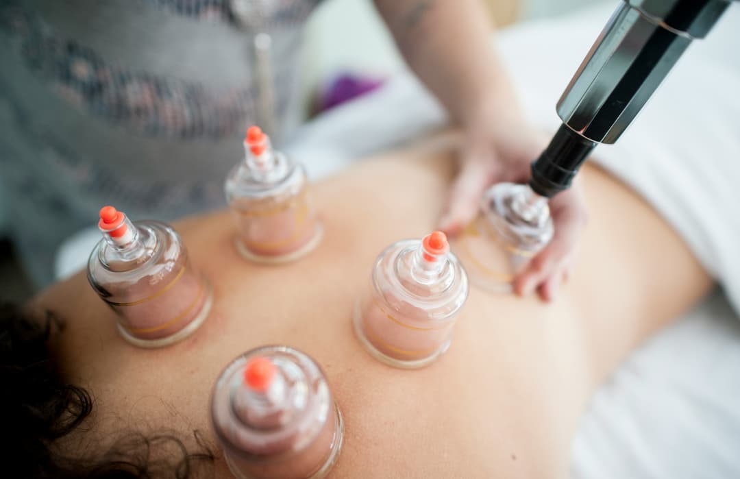 picture of cupping therapy